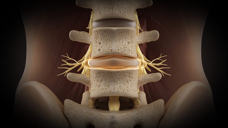 Anatomical illustration of a spinal disc sagging outward evenly around its edge between two vertebrae.